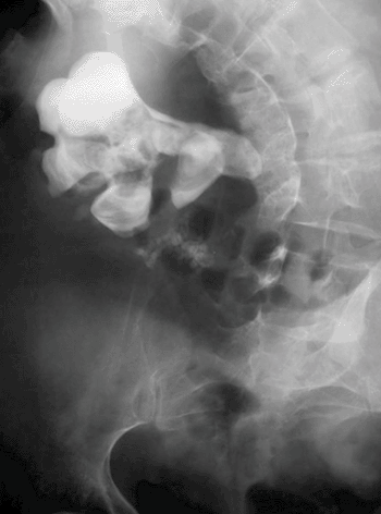 Image: A large staghorn calculus involving the major calyces and renal pelvis (Photo courtesy of Nevit Dilmen, Wikimedia Commons). Image: A large staghorn calculus involving the major calyces and renal pelvis (Photo courtesy of Nevit Dilmen, Wikimedia Commons).
